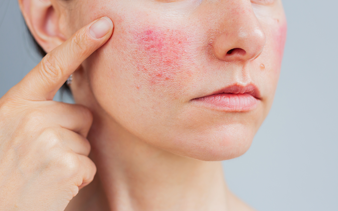 How UPF 50+ Sun Protection Can Help Alleviate Rosacea